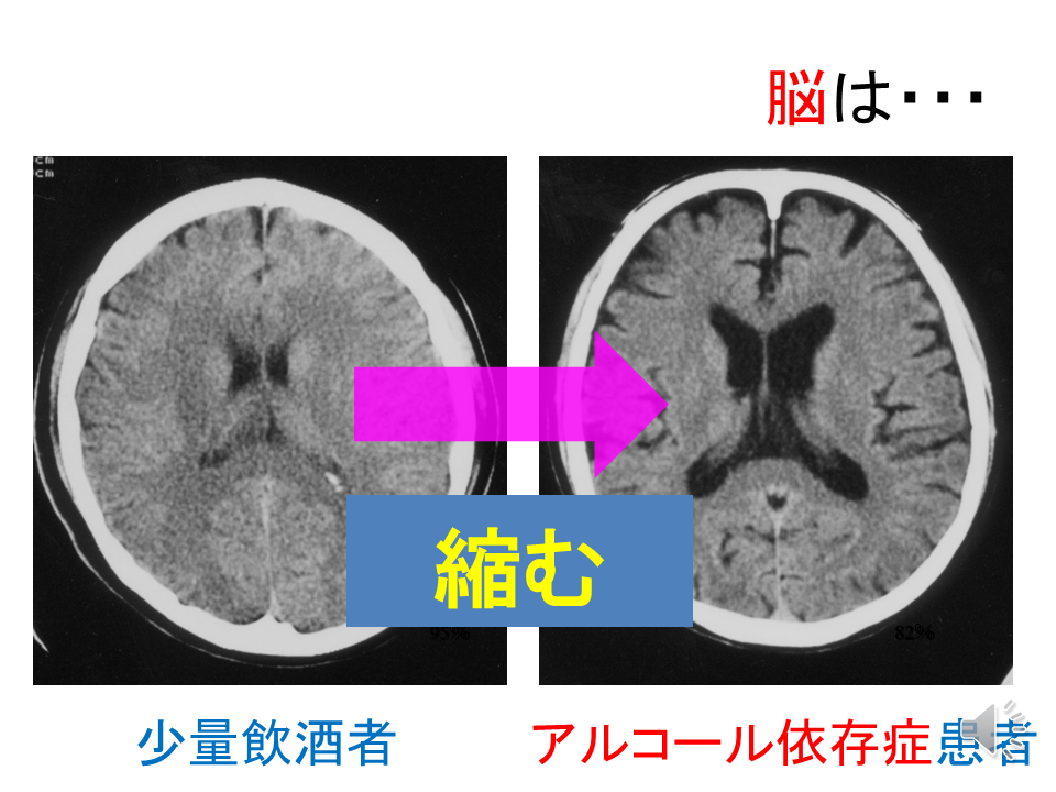 アルコールはあなたの精神的健康にどのような影響を与えますか?